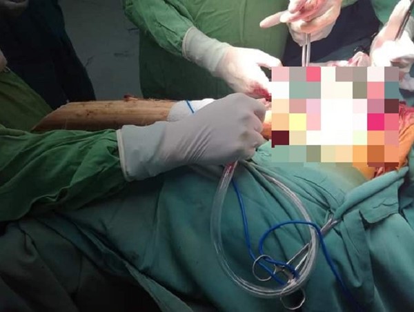 Quảng Ngãi: Cấp cứu nam thanh niên bị cây đâm xuyên ngực khi gặp tai nạn giao thông