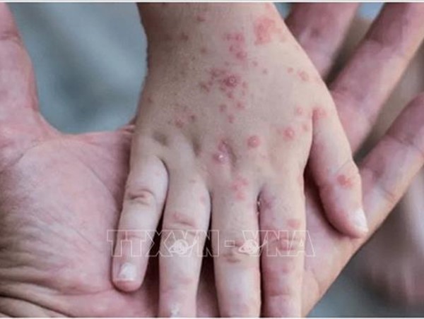 Phát hiện ca đậu mùa khỉ đầu tiên ở Đông Nam Á, Việt Nam siết chặt kiểm dịch tại cửa khẩu