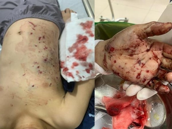 Quảng Ninh: Bé trai 10 tuổi bị đa chấn thương do đồ chơi chứa pin phát nổ