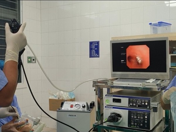 Cấp cứu thành công bé trai bị đinh vít dài 1,5cm găm vào phế quản