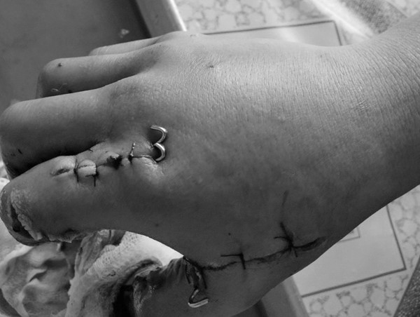 Hải Phòng: Nhiều bệnh nhi nhập viện do liên quan đến pháo nổ