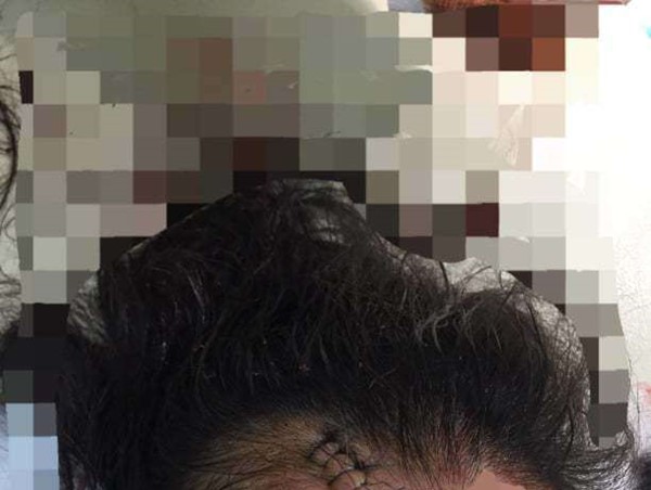 Truy tìm tài xế Mazda CX5 gây tai nạn khiến một cô gái bị thương nặng