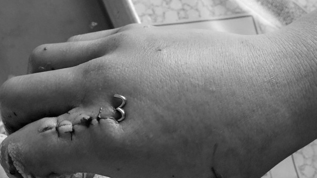 Hải Phòng: Nhiều bệnh nhi nhập viện do liên quan đến pháo nổ